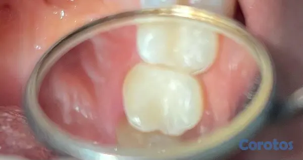 servicios profesionales - PROCEDIMIENTOS DENTALES 3