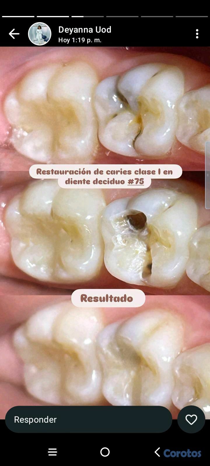 equipos profesionales - limpieza y caries  para niños (Ver imágenes y leer la descripción)
 4