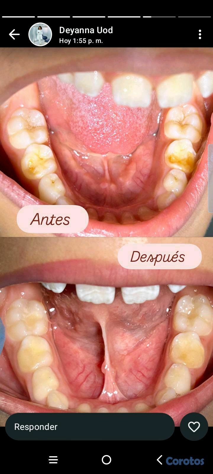 equipos profesionales - limpieza y caries  para niños (Ver imágenes y leer la descripción)
 3