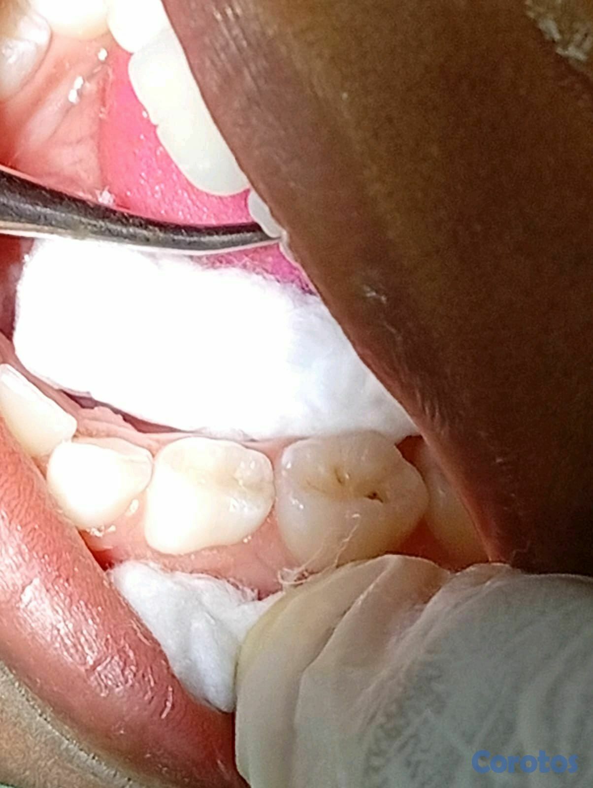 equipos profesionales - limpieza y caries  para niños (Ver imágenes y leer la descripción)
 5