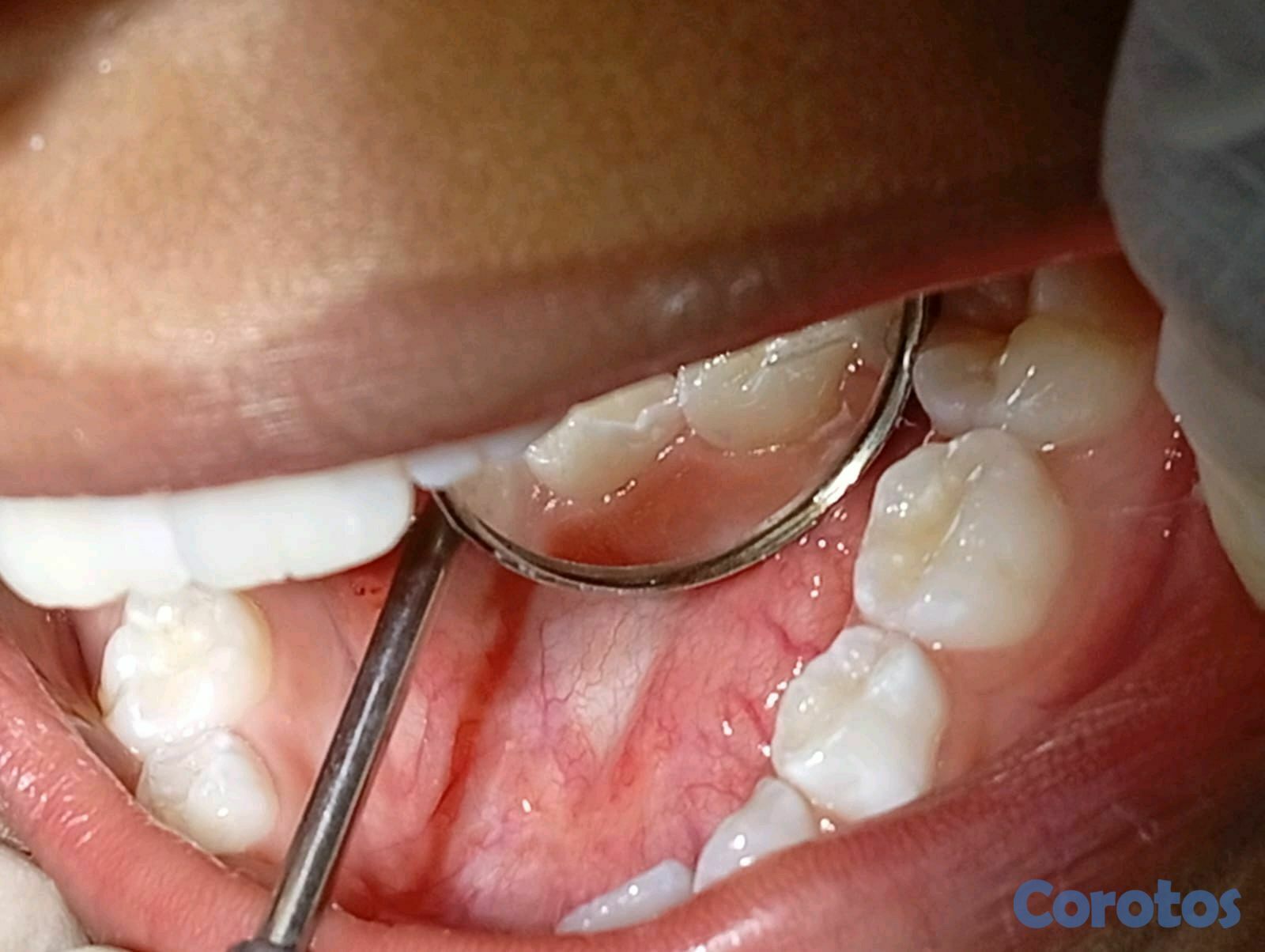 equipos profesionales - limpieza y caries  para niños (Ver imágenes y leer la descripción)
 6